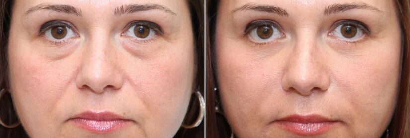 Pirms un pēc blefaroplastikas - taukainā ķermeņa noņemšana zem acīm un ādas pievilkšana